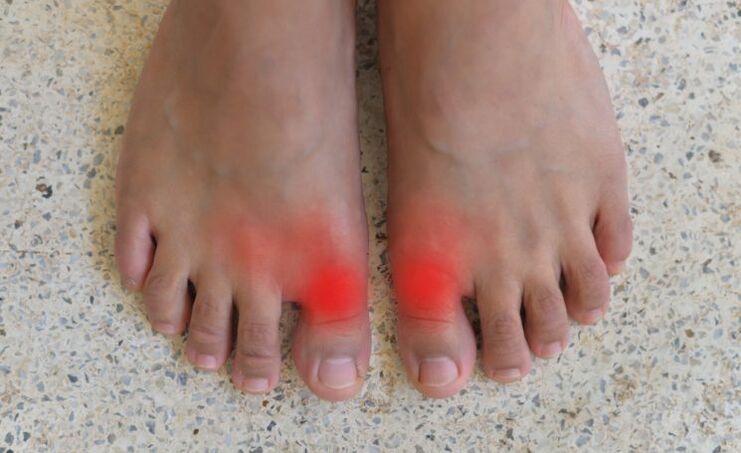 Pain in the big toe due to gout